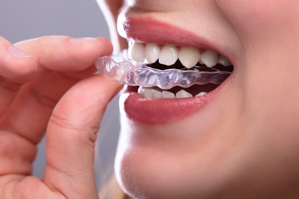 clear braces aligners